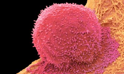 Innovative new cell therapies could finally get at tough-to-target cancers